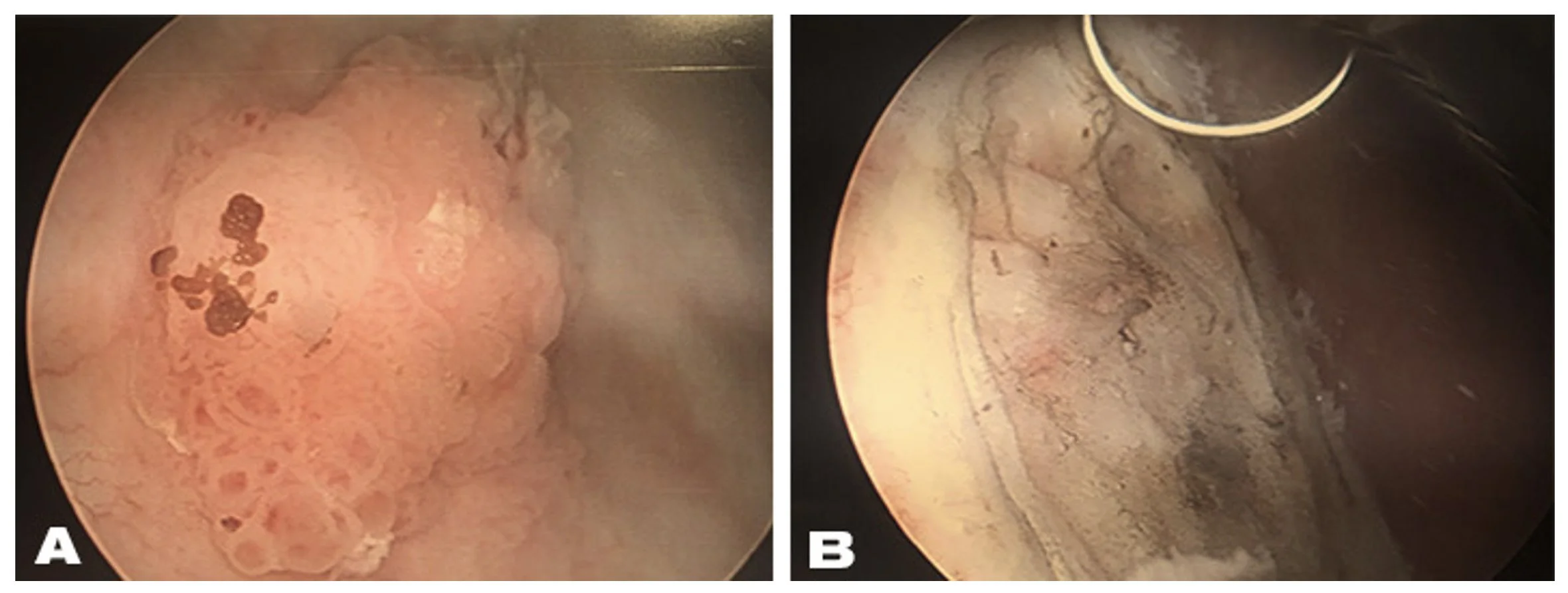 Surgeon utilizing endoscopic monitors for precision tumor removal