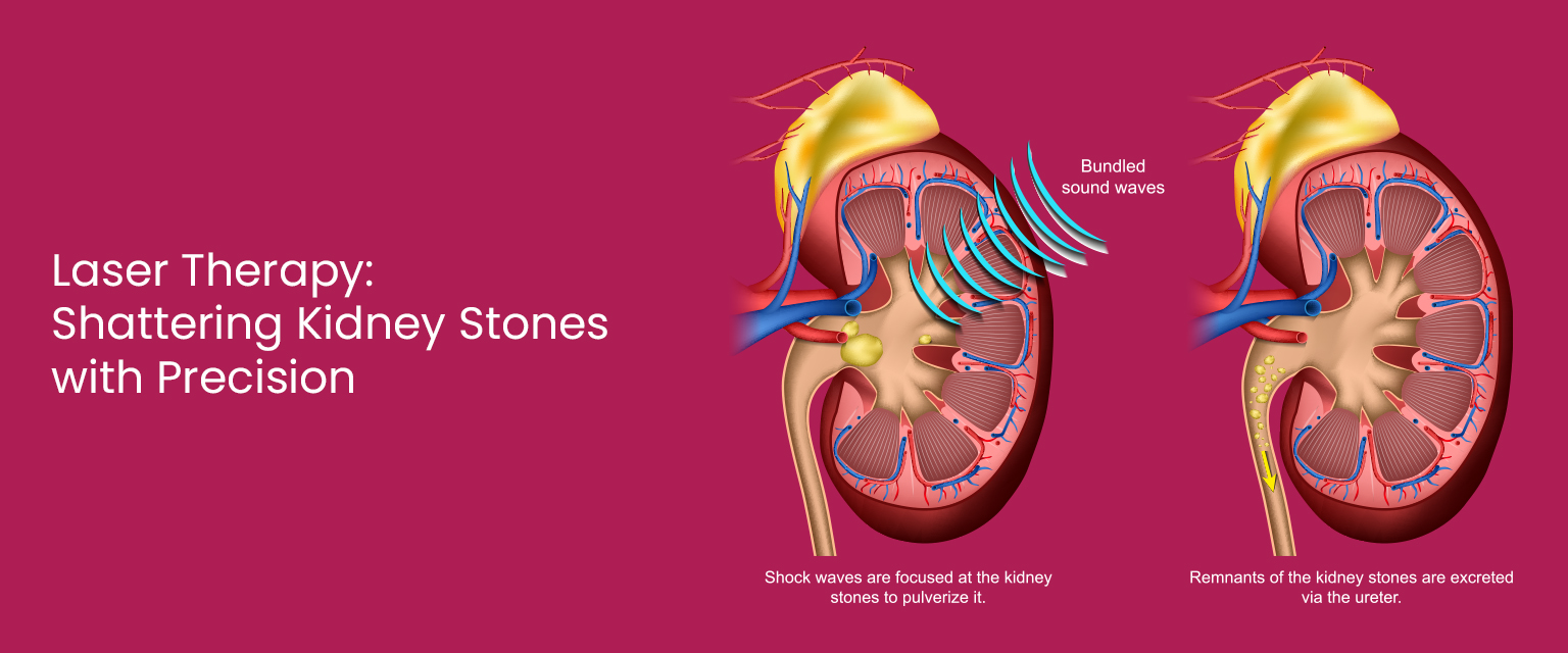 Surgeon performing laser-guided stone removal