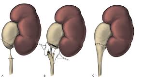 Surgical precision focusing on internal organ reconstruction