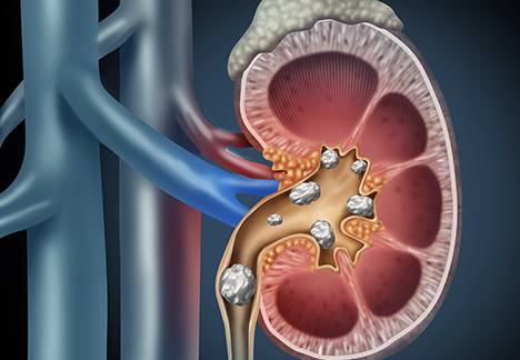 Advanced Extracorporeal Shock Wave Lithotripsy Equipment